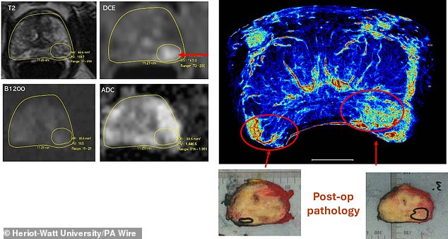 MRI images (left) and new super-resolution images (right) showing a missed tumor