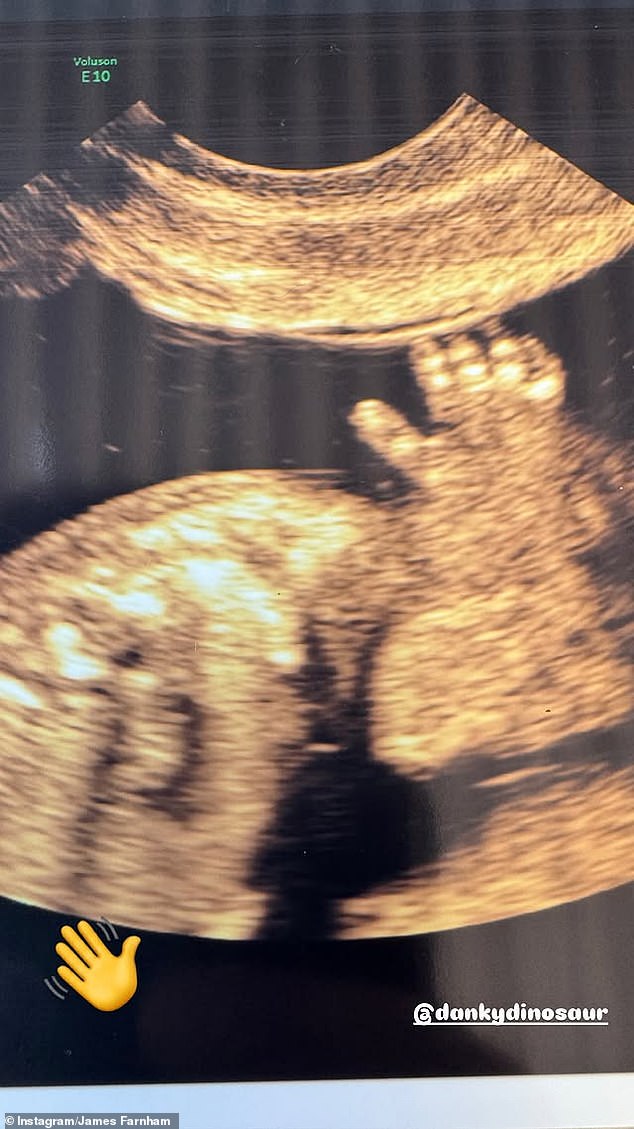 He also shared a photo of his partner's ultrasound, which showed their unborn baby's hand