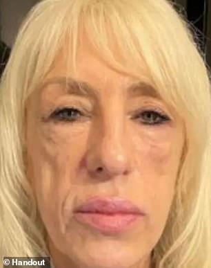 Andrea said she was scared both mentally and physically. She has pain in her face (shown with scarring after treatment) and has been diagnosed with post-traumatic stress disorder.