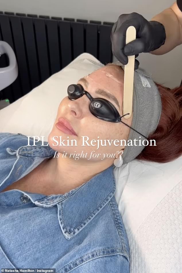 In November 2024, Natasha underwent laser treatment to improve pigmentation, sun spots, acne scars, sun damage, rosacea, freckles, vascular lesions (threaded veins, varicose veins, port wine stains, telangiectasia) and uneven skin tone.