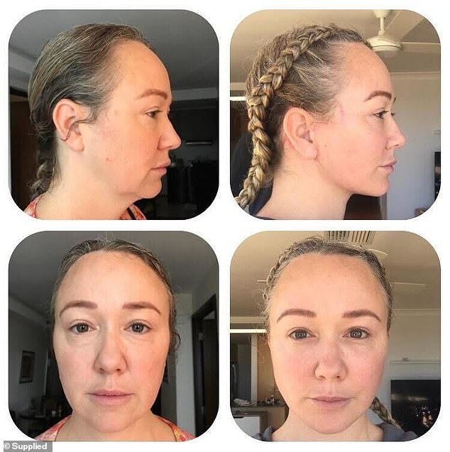 I was in Manila for two weeks before the doctor cleared me to fly home. (Photo: Jonica before and after her facelift, from the front and from the side)