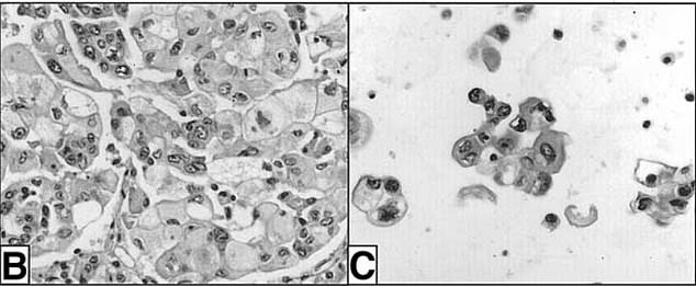 Sample B shows tumor cells in the donor's right lung and square C shows features in the recipient's tumor cells, which 'have characteristics similar to donor tumor cells'