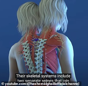 The twins have two spines that meet at the pelvis