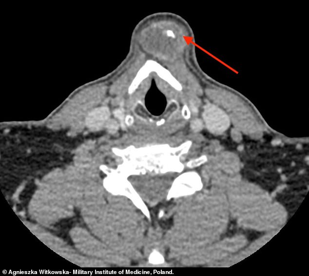 The arrow shows the lump in the throat of the 46-year-old patient. Doctors tried to cut it out before suspecting he had cancer