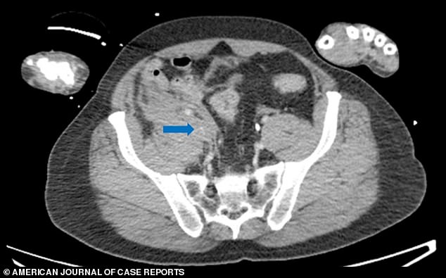 The blue arrow points to a hematoma, or blood collection, around the iliac vein, which helped control bleeding after the man was impaled by a pipe