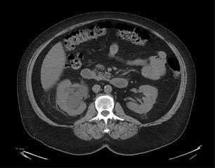 This CT scan was taken after the kidney stones had broken