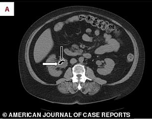 This CT scan shows the gas-filled stones in the woman's kidney area