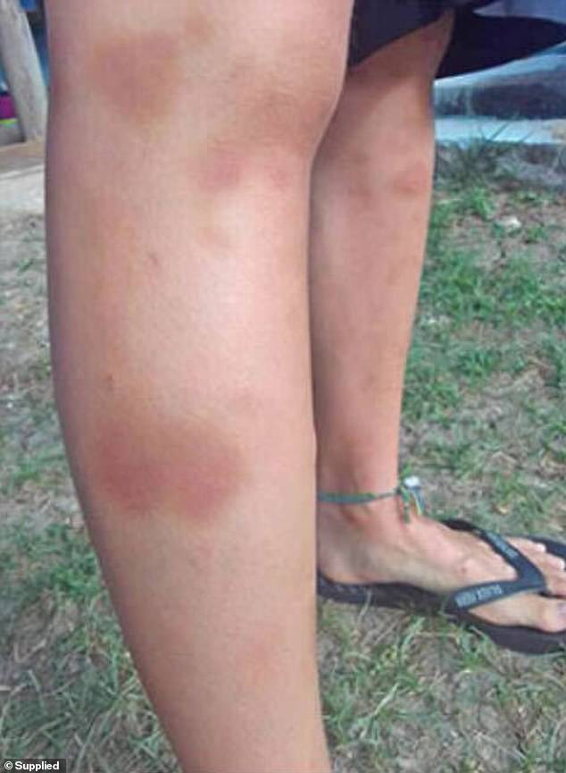 The victim shared a series of bruises she claims she suffered during the alleged attack with Daily Mail Australia