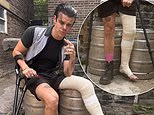 Yungblud has huge cast and crutches after 'breaking his leg in horror motorcycle accident'