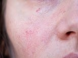 What that crusty red spot on your face really means: So many are told that the sign that won't go away is eczema or psoriasis. But here's how you can tell if it's something much more sinister, reveals Dr PHILLIPA KAYE