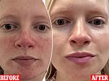 I've tried everything for rosacea, but then a High Street serum transformed my skin... it's really worth the hype