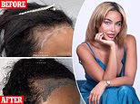 My signature sleek ponytail and hair extensions left me with a hairline that had receded 3 inches and bald spots. Minoxidil did not help and a transplant failed. This is what finally gave me my hair back