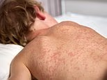 Measles outbreaks in multiple states could leave thousands exposed as the US records its first deaths this year
