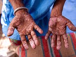 Deadly ancient disease is making a comeback in the US, experts warn... as they reveal the surprising reason why and how you can protect yourself